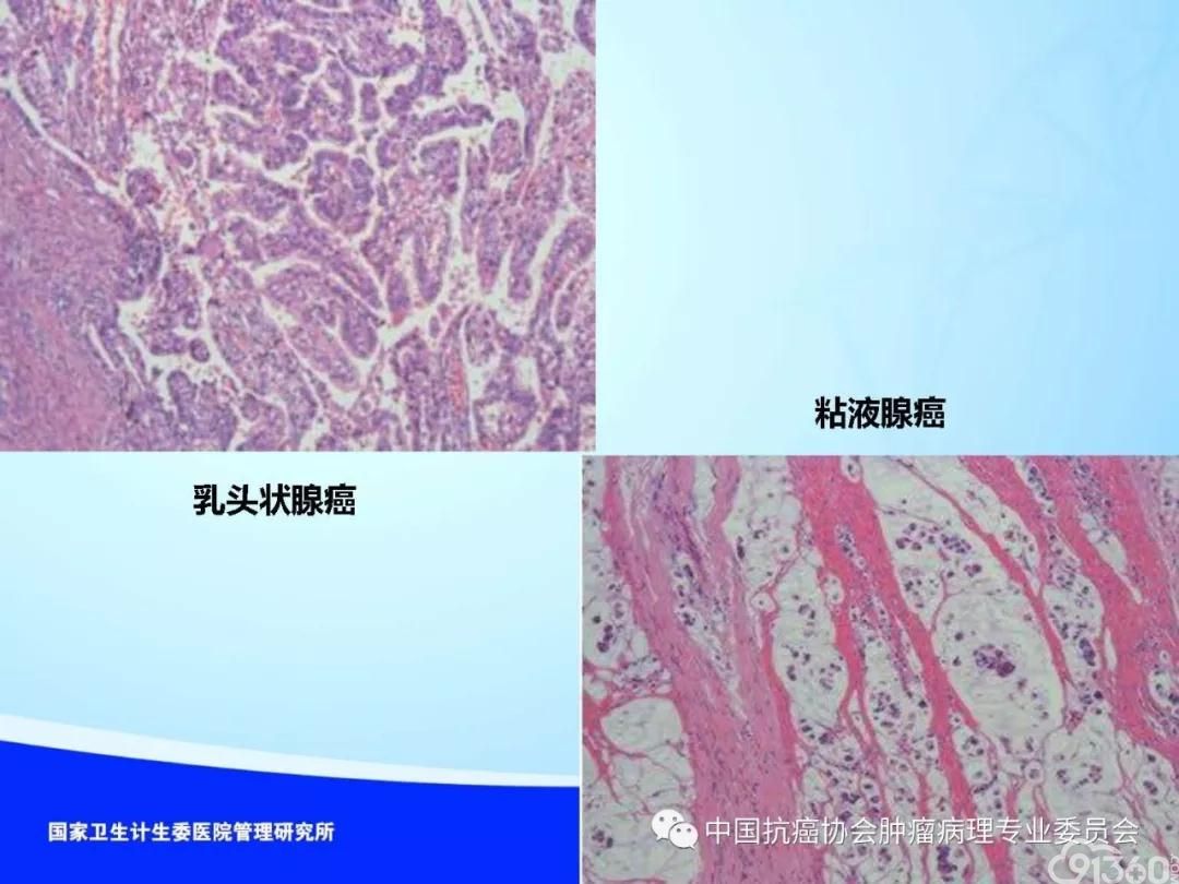 肿瘤病理规范化诊断标准 第4部分:胃癌病理诊断标准