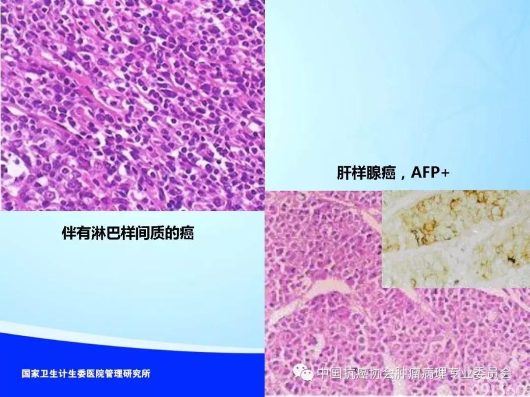 肿瘤病理规范化诊断标准 第4部分:胃癌病理诊断标准