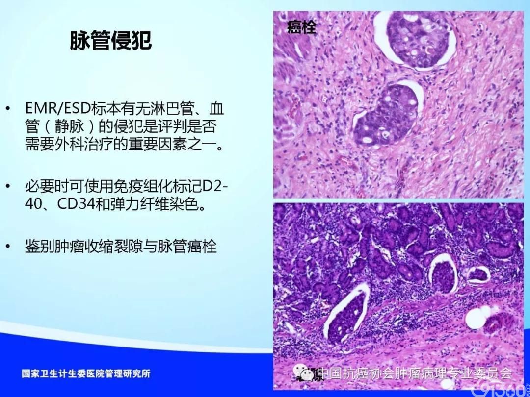 肿瘤病理规范化诊断标准 第4部分:胃癌病理诊断标准