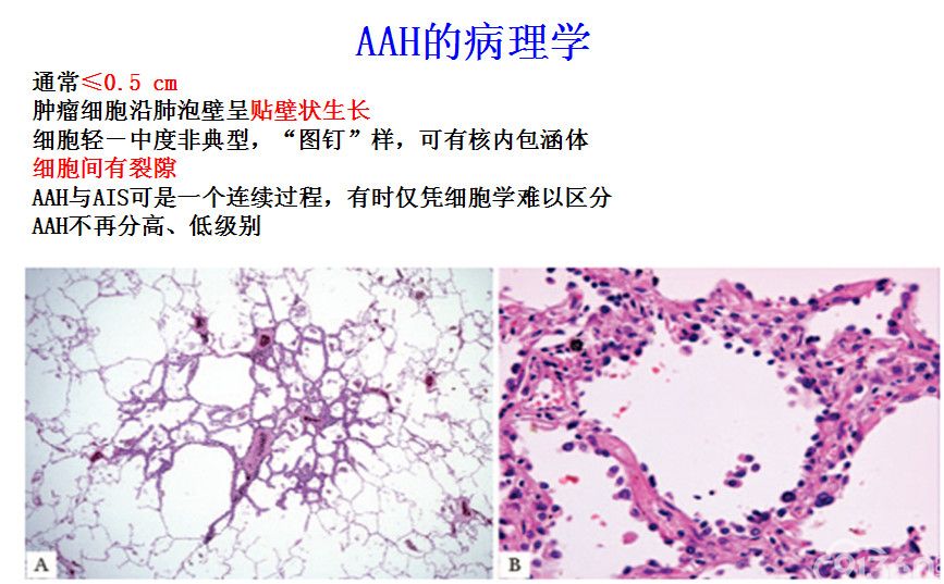肺癌浸润前病变-不典型腺瘤样增生