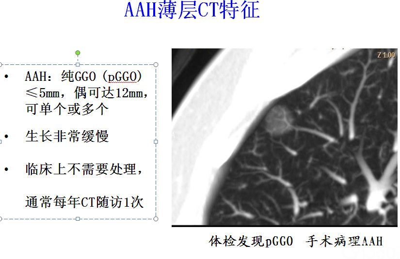 肺癌浸润前病变-不典型腺瘤样增生