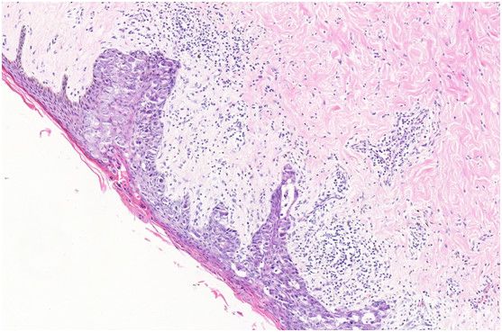 【病例分享】乳头paget病
