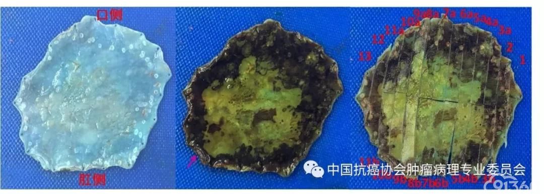 图1内镜下黏膜切除术(EMR)/内镜下黏膜下剥离术(ESD)标本取材示意图(箭头为最近侧切缘)