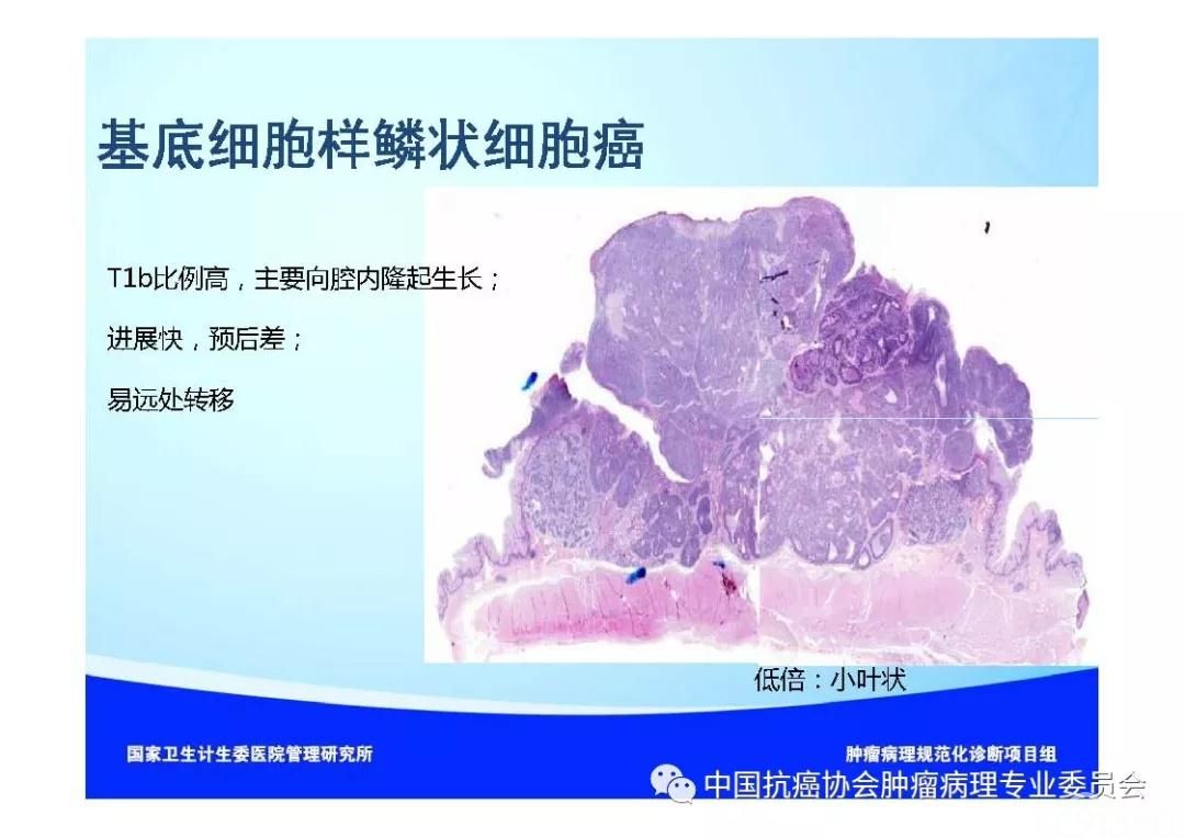 肿瘤病理规范化诊断标准 第7部分:食管癌病理诊断标准