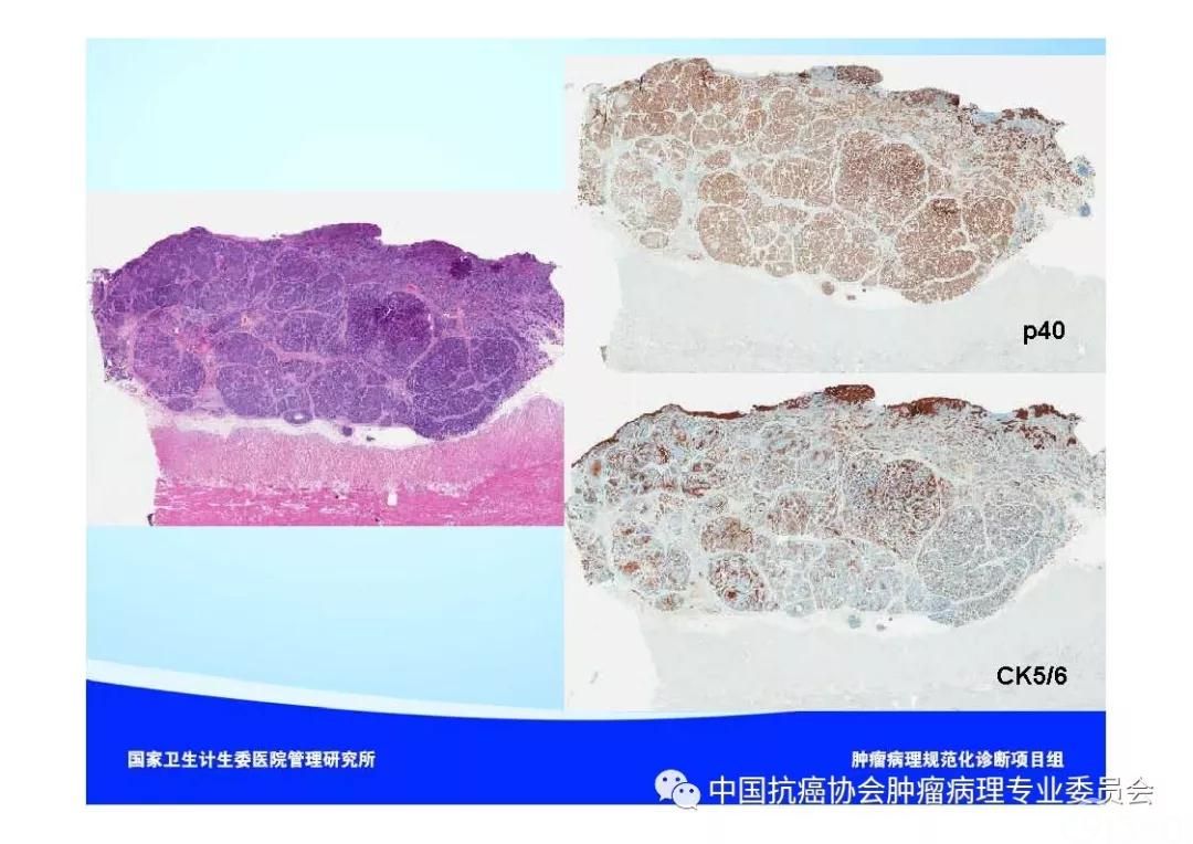 肿瘤病理规范化诊断标准 第7部分:食管癌病理诊断标准