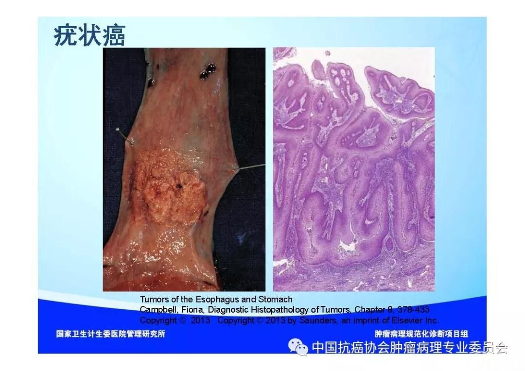 肿瘤病理规范化诊断标准 第7部分:食管癌病理诊断标准