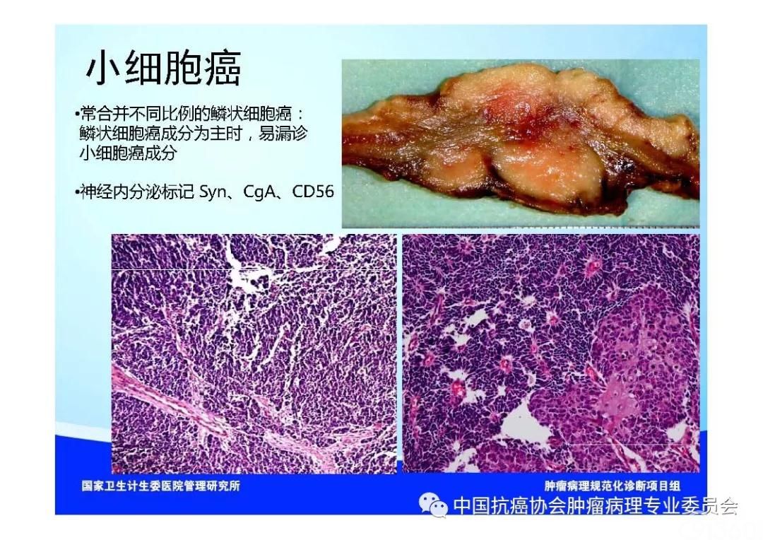 肿瘤病理规范化诊断标准 第7部分:食管癌病理诊断标准