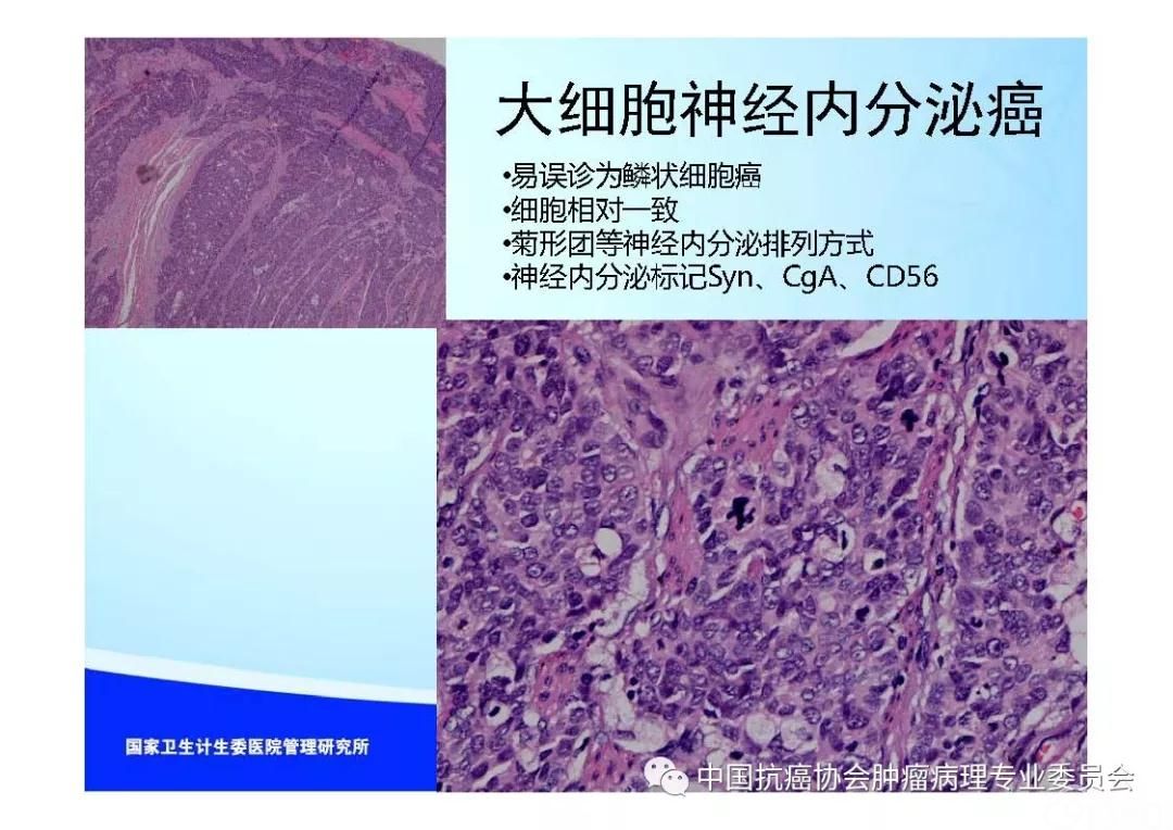 肿瘤病理规范化诊断标准 第7部分:食管癌病理诊断标准