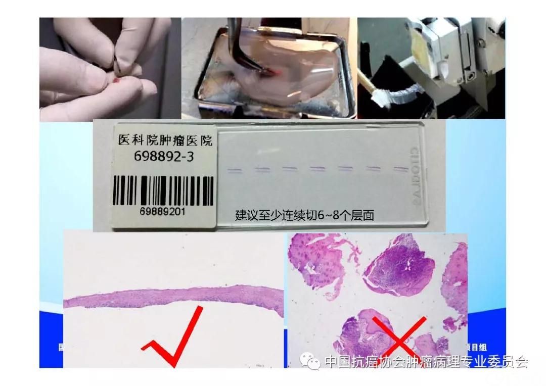 肿瘤病理规范化诊断标准 第7部分:食管癌病理诊断标准