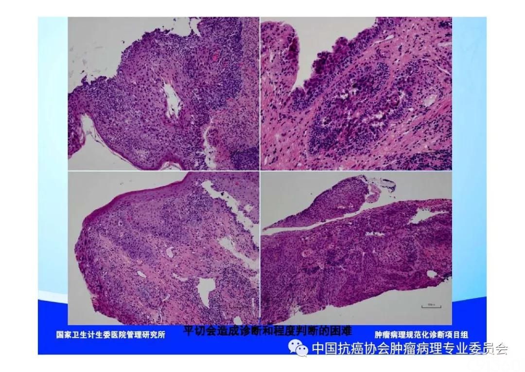 肿瘤病理规范化诊断标准 第7部分:食管癌病理诊断标准