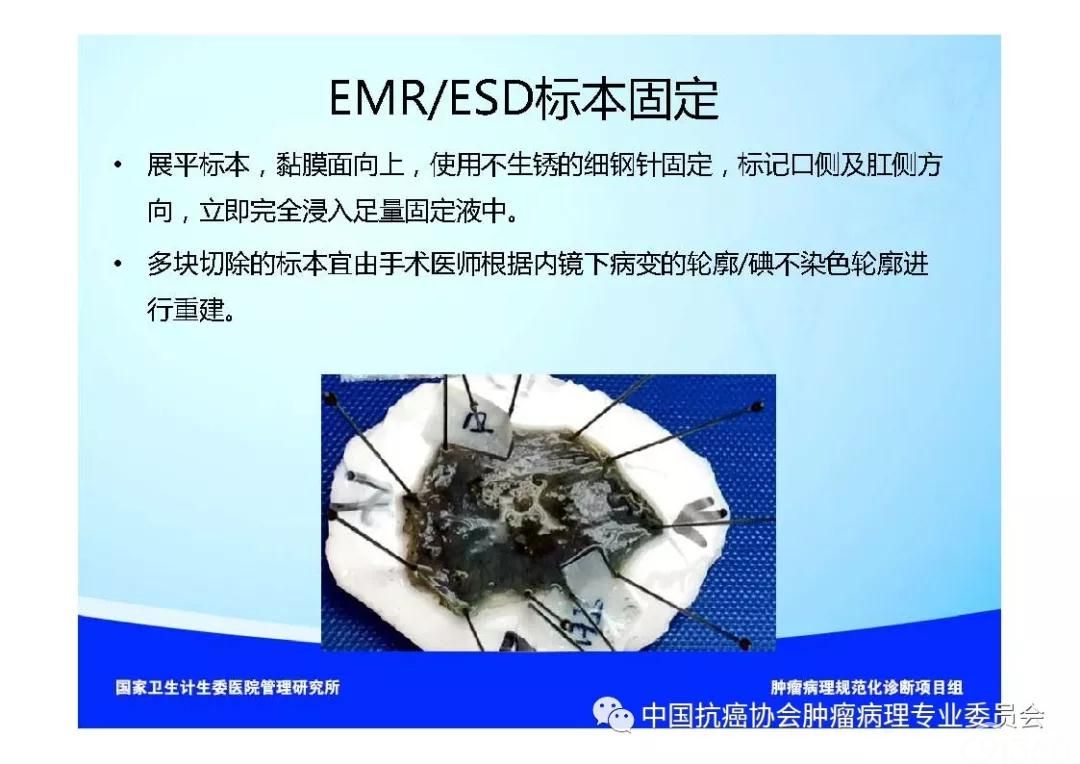 肿瘤病理规范化诊断标准 第7部分:食管癌病理诊断标准