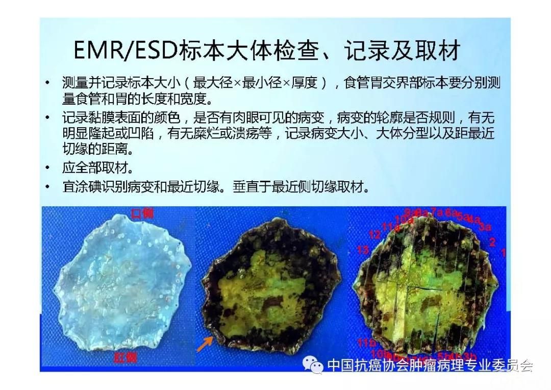 肿瘤病理规范化诊断标准 第7部分:食管癌病理诊断标准