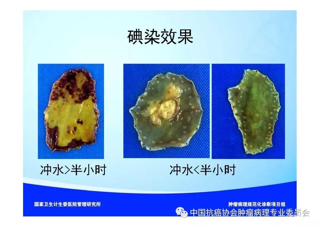 肿瘤病理规范化诊断标准 第7部分:食管癌病理诊断标准