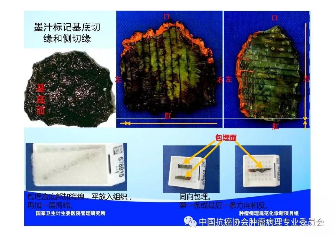 肿瘤病理规范化诊断标准 第7部分:食管癌病理诊断标准