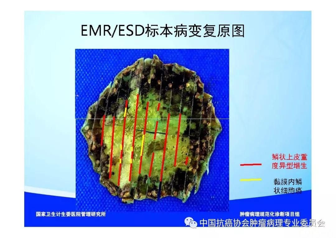 肿瘤病理规范化诊断标准 第7部分:食管癌病理诊断标准