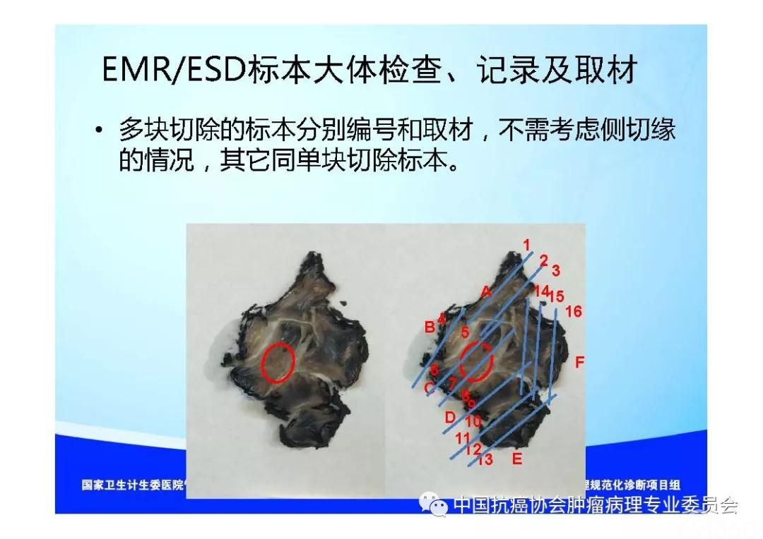 肿瘤病理规范化诊断标准 第7部分:食管癌病理诊断标准