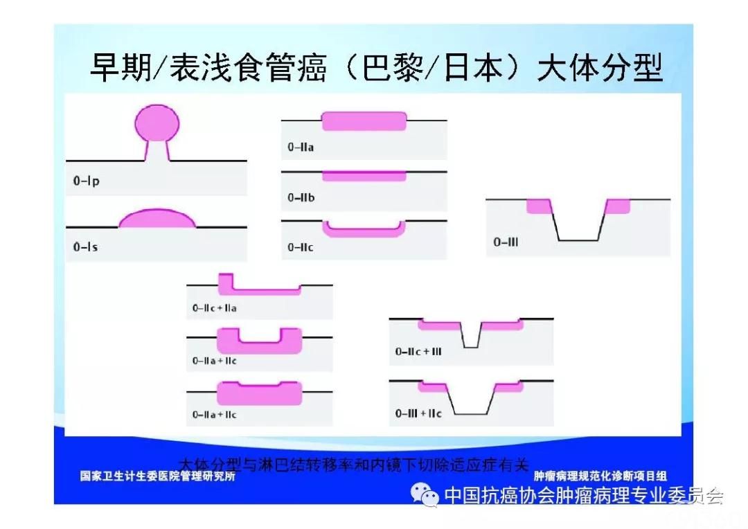 肿瘤病理规范化诊断标准 第7部分:食管癌病理诊断标准