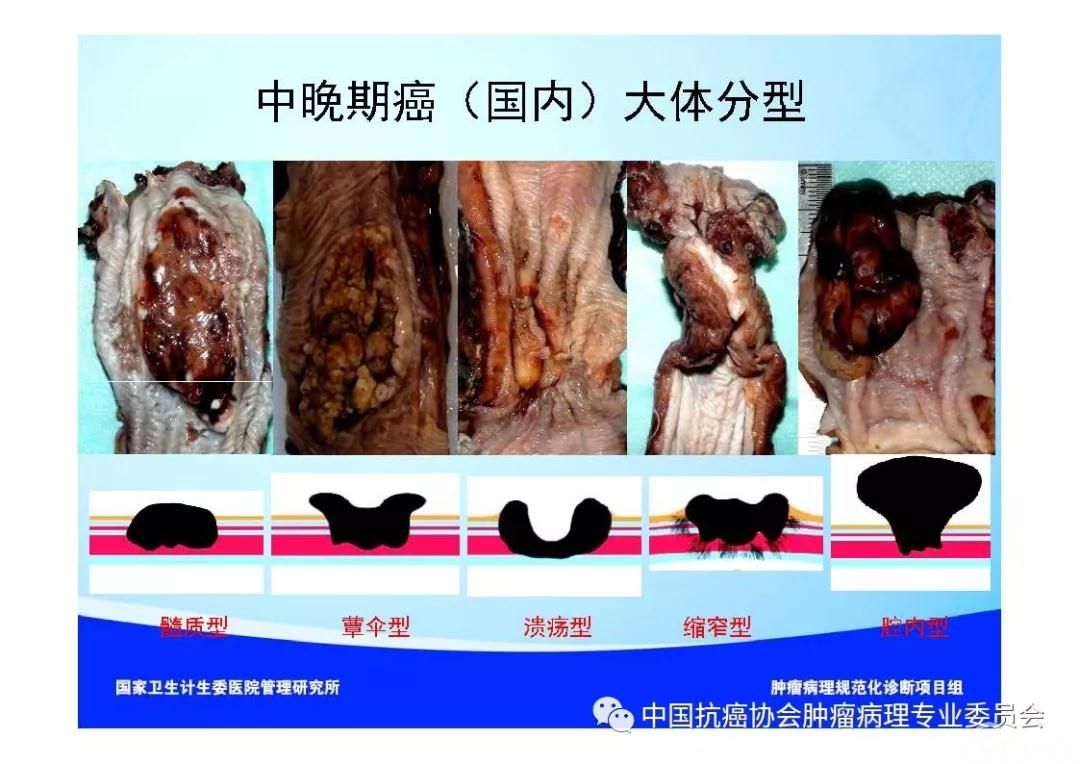 肿瘤病理规范化诊断标准 第7部分:食管癌病理诊断标准