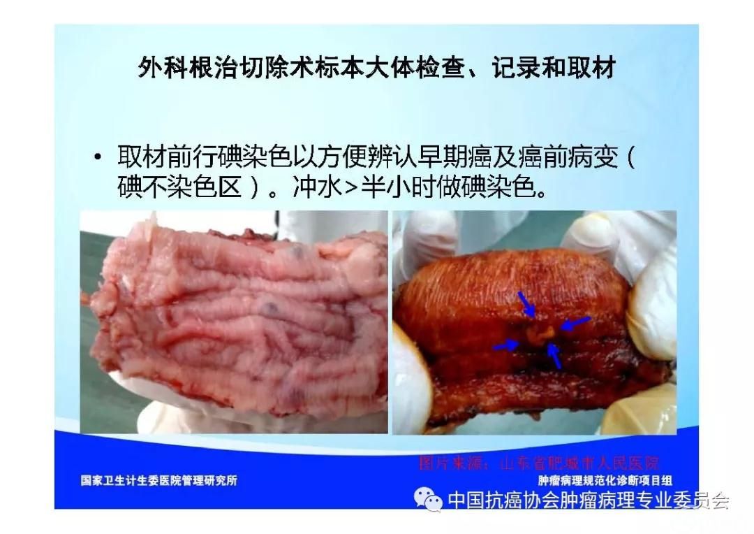 肿瘤病理规范化诊断标准 第7部分:食管癌病理诊断标准