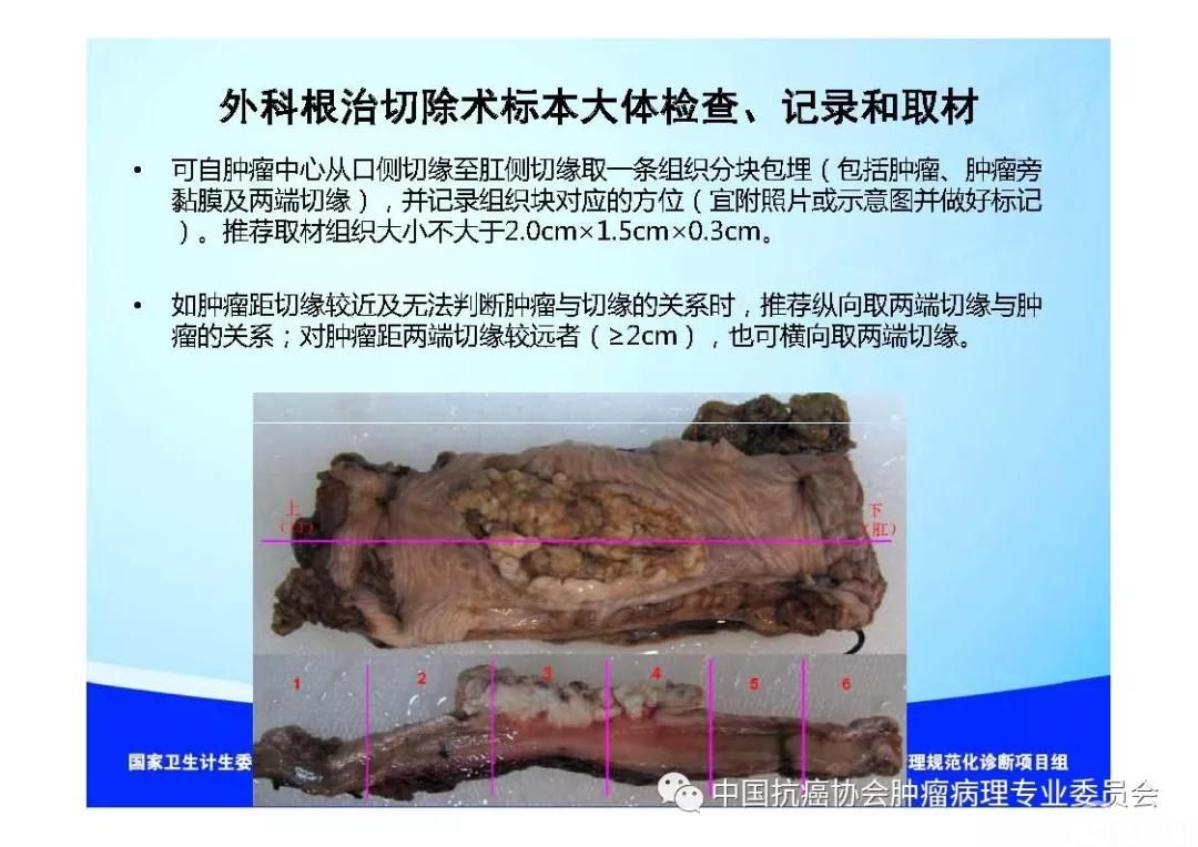 肿瘤病理规范化诊断标准 第7部分:食管癌病理诊断标准