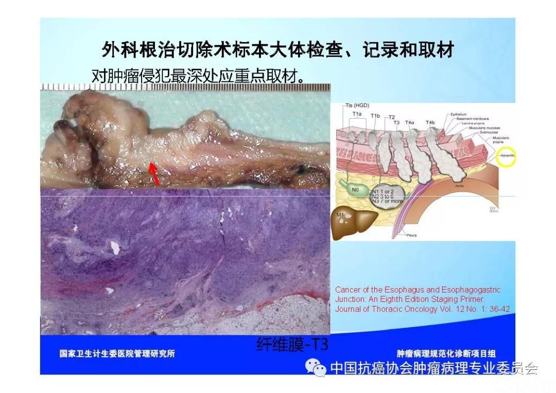 肿瘤病理规范化诊断标准 第7部分:食管癌病理诊断标准