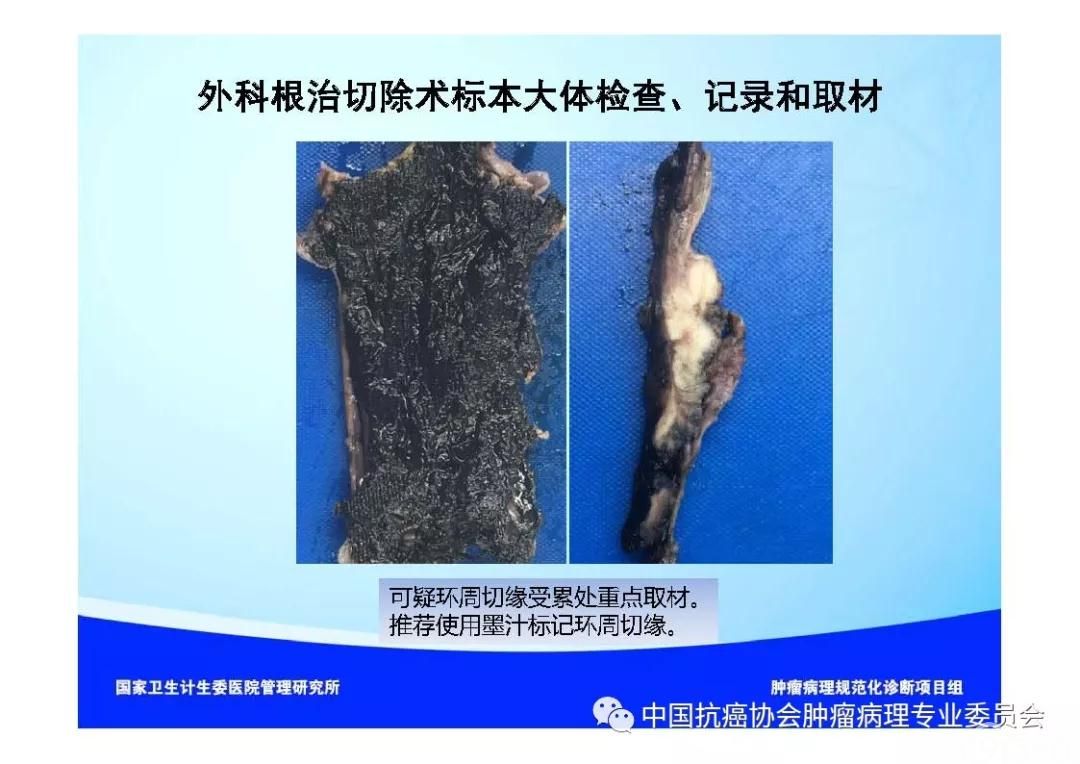 肿瘤病理规范化诊断标准 第7部分:食管癌病理诊断标准