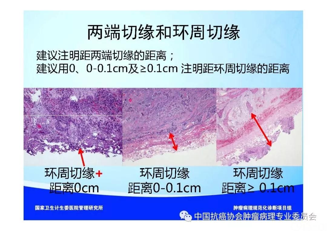 肿瘤病理规范化诊断标准 第7部分:食管癌病理诊断标准
