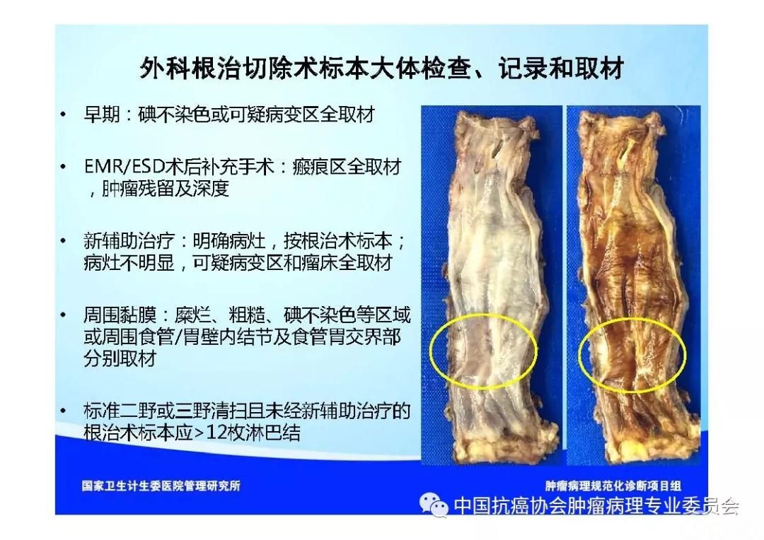 肿瘤病理规范化诊断标准 第7部分:食管癌病理诊断标准