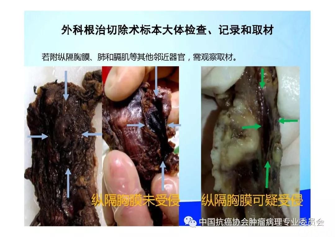肿瘤病理规范化诊断标准 第7部分:食管癌病理诊断标准