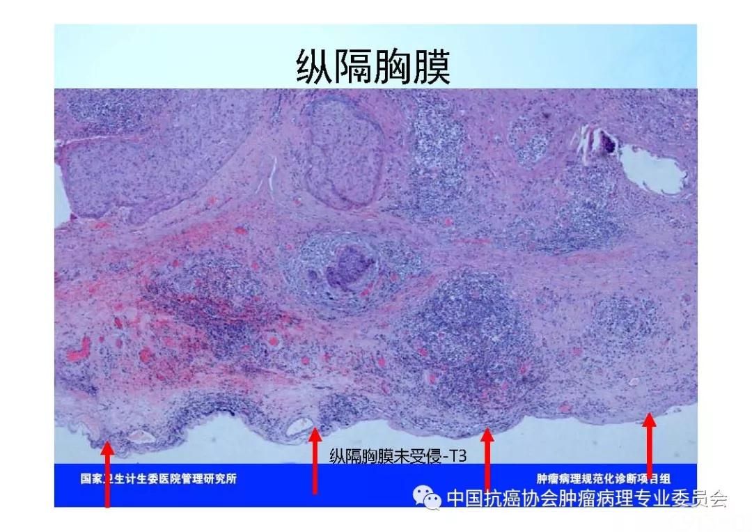 肿瘤病理规范化诊断标准 第7部分:食管癌病理诊断标准