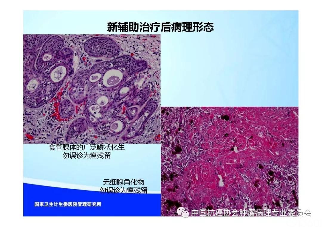 肿瘤病理规范化诊断标准 第7部分:食管癌病理诊断标准