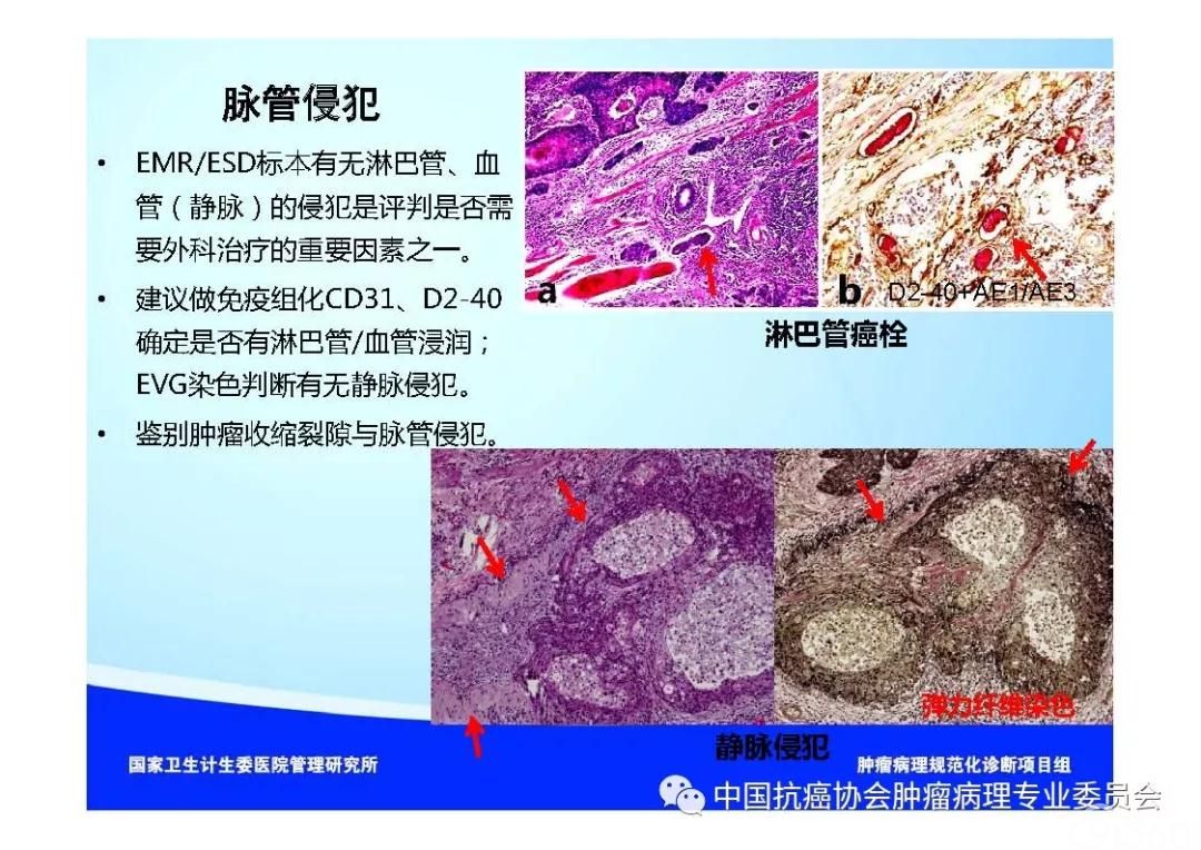 肿瘤病理规范化诊断标准 第7部分:食管癌病理诊断标准