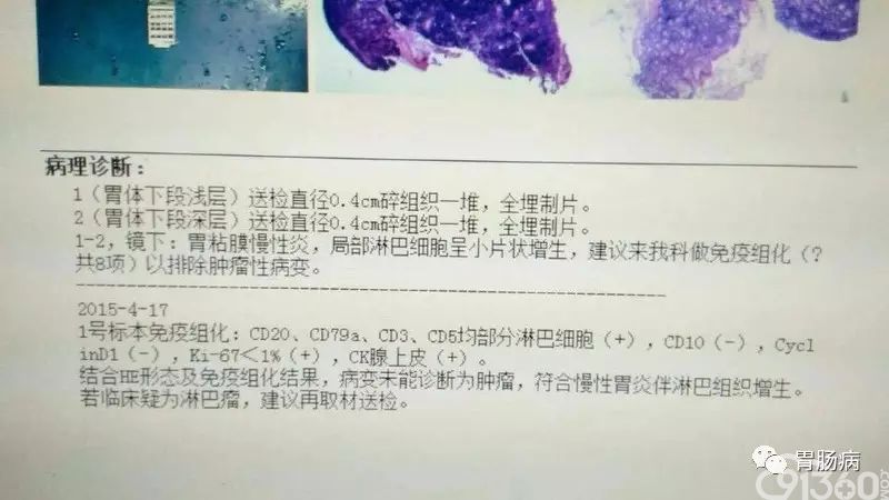 一文看懂胃镜活检报告