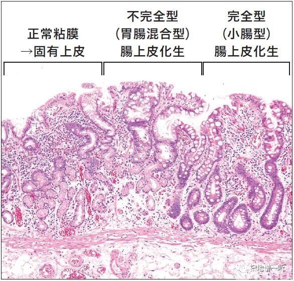 医学美图 胃 肠化の免疫组化基础