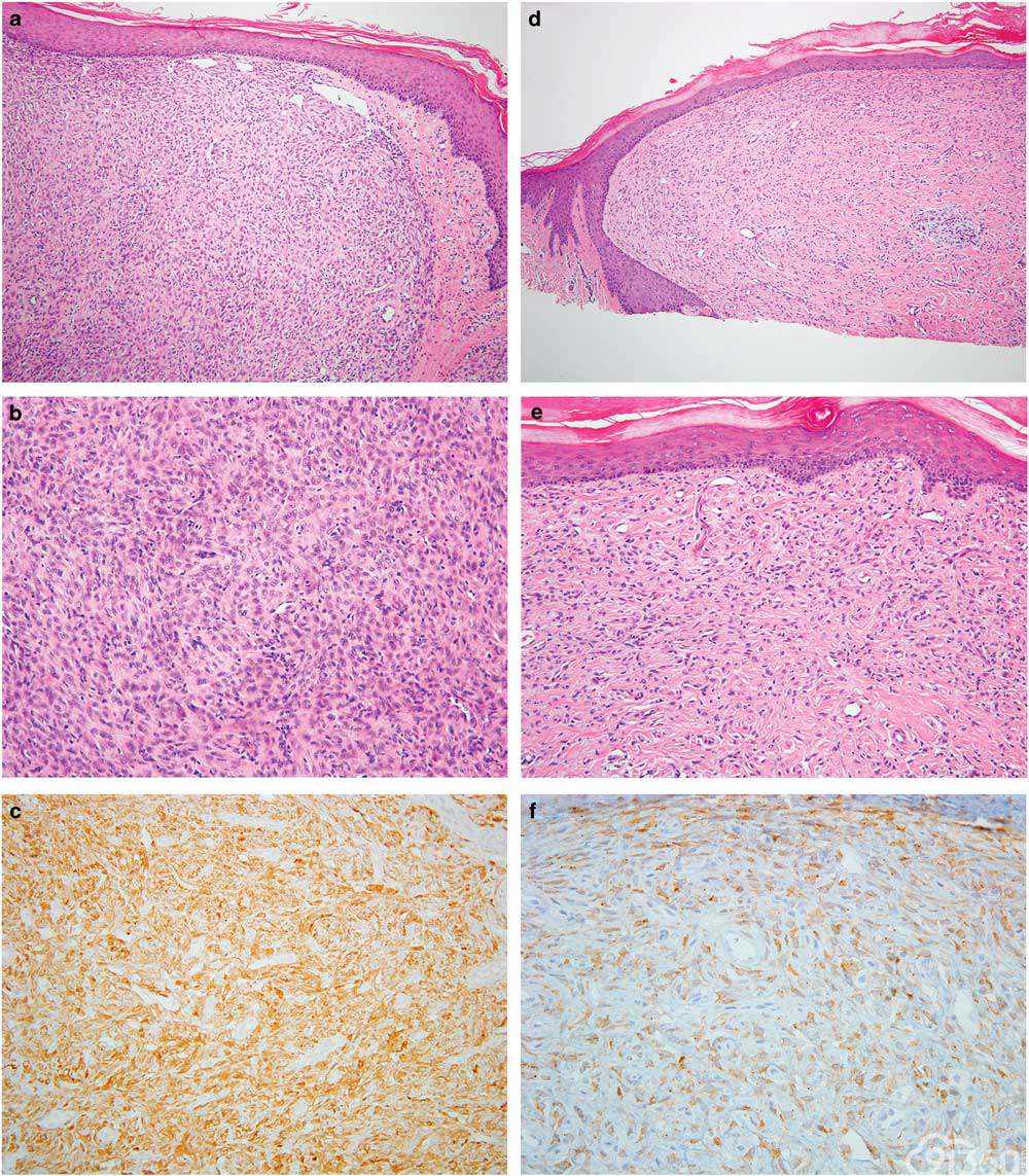 图5 伴有(a-c) PPFIBP1-ALK和(d-f) SPECC1L-ALK融合产物的上皮样纤维组织细胞瘤的的代表性显微图片。纤细的周围血管是大多数肿瘤中常见的表现。 注意：具有SPECC1L-ALK 易位的上皮样纤维组织细胞瘤中散在分布的胶原性间质。(a和d) (HE×100)；(b和e) (HE×200)；(c和f) (ALK免疫组化×200)。