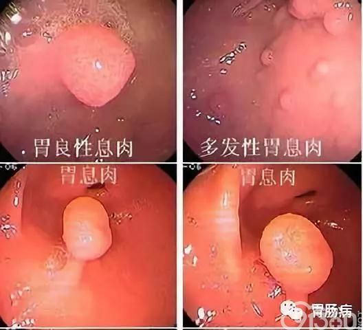 病理科普 列表 胃息肉一般多为良性,无症状者勿需治疗.