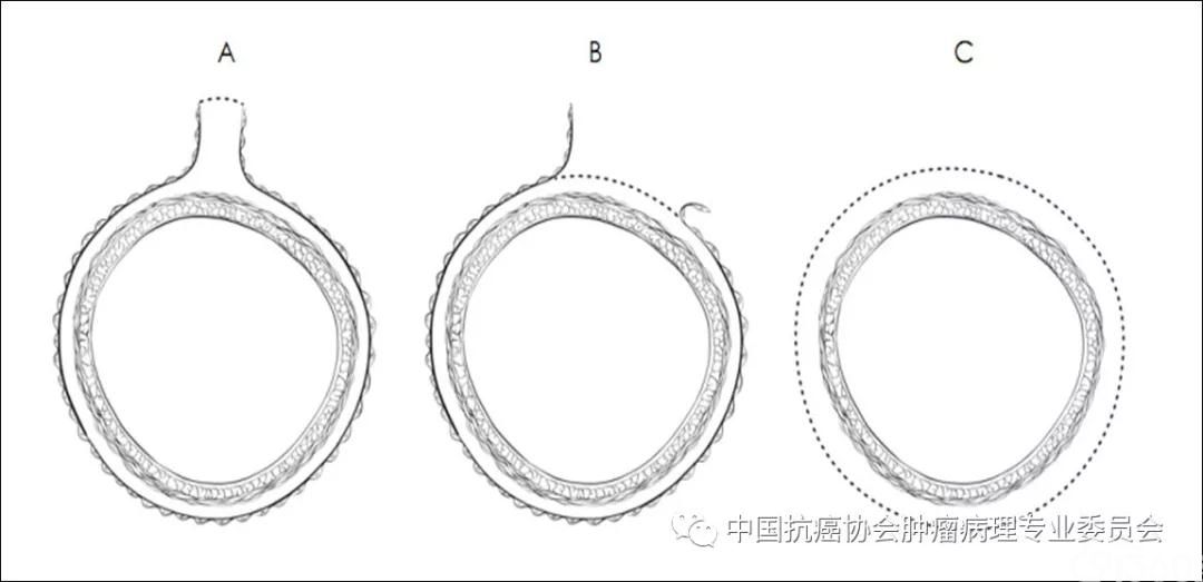 肿瘤病理诊断规范 第9部分:结直肠癌病理诊断规范