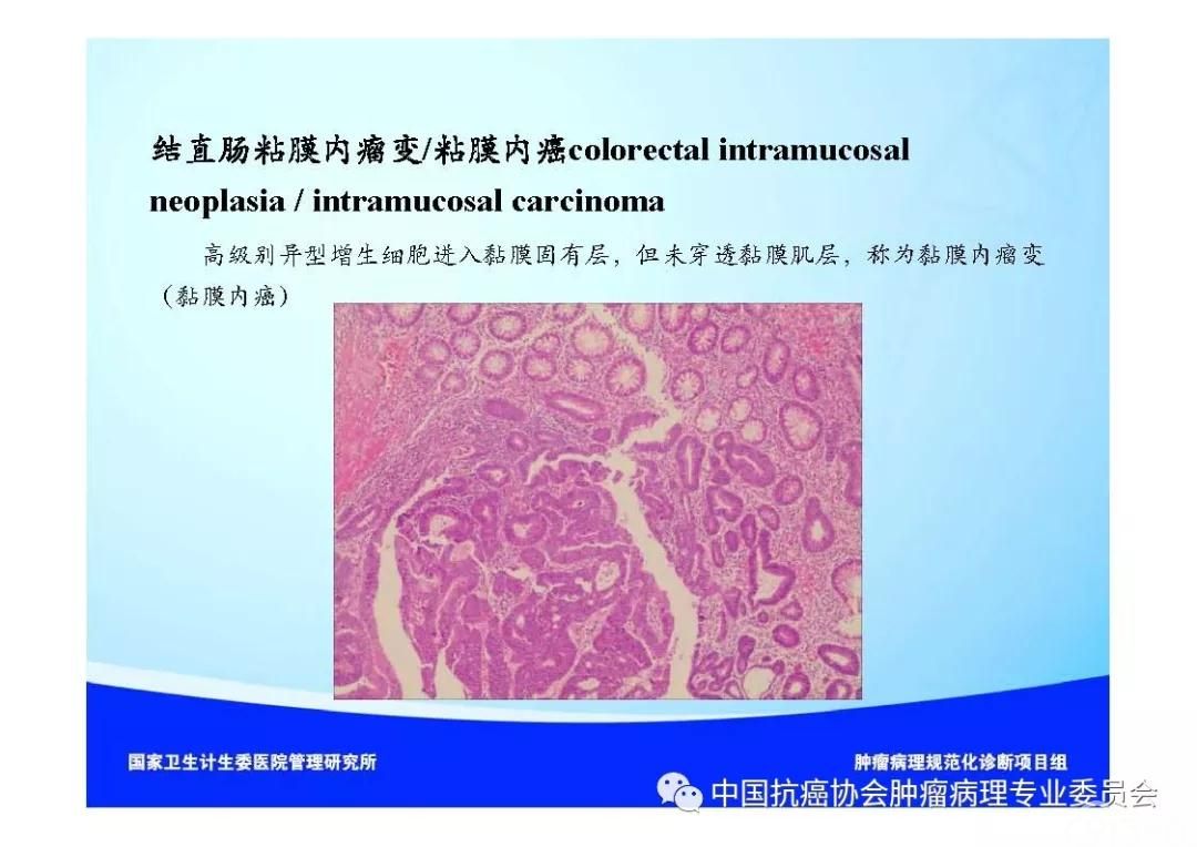 肿瘤病理诊断规范 第9部分:结直肠癌病理诊断规范