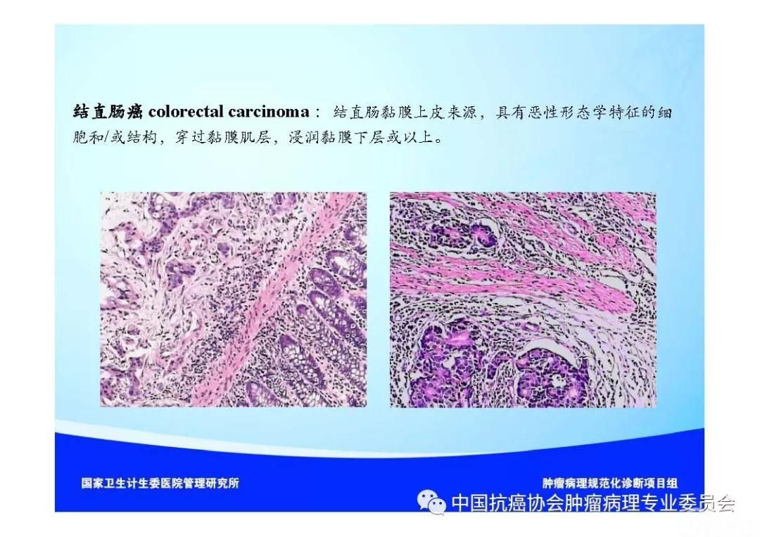 肿瘤病理诊断规范 第9部分:结直肠癌病理诊断规范