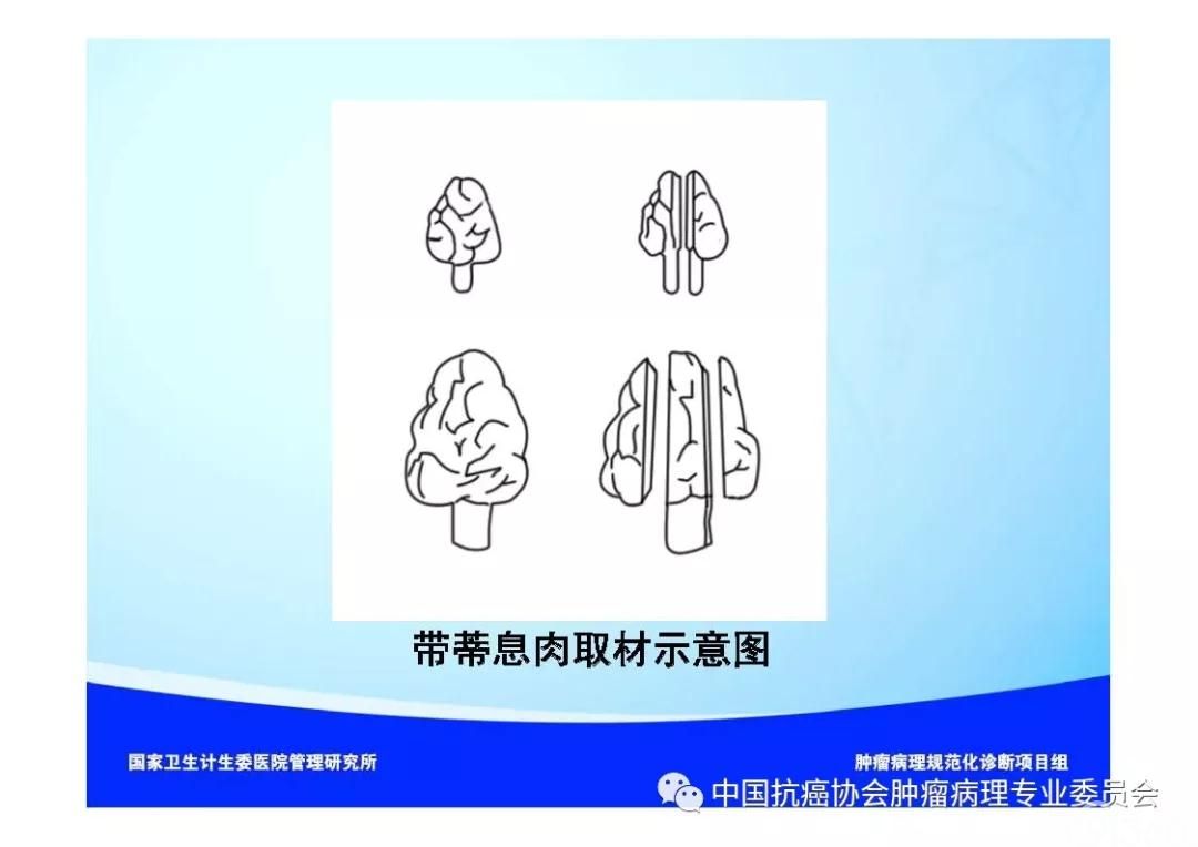 肿瘤病理诊断规范 第9部分:结直肠癌病理诊断规范