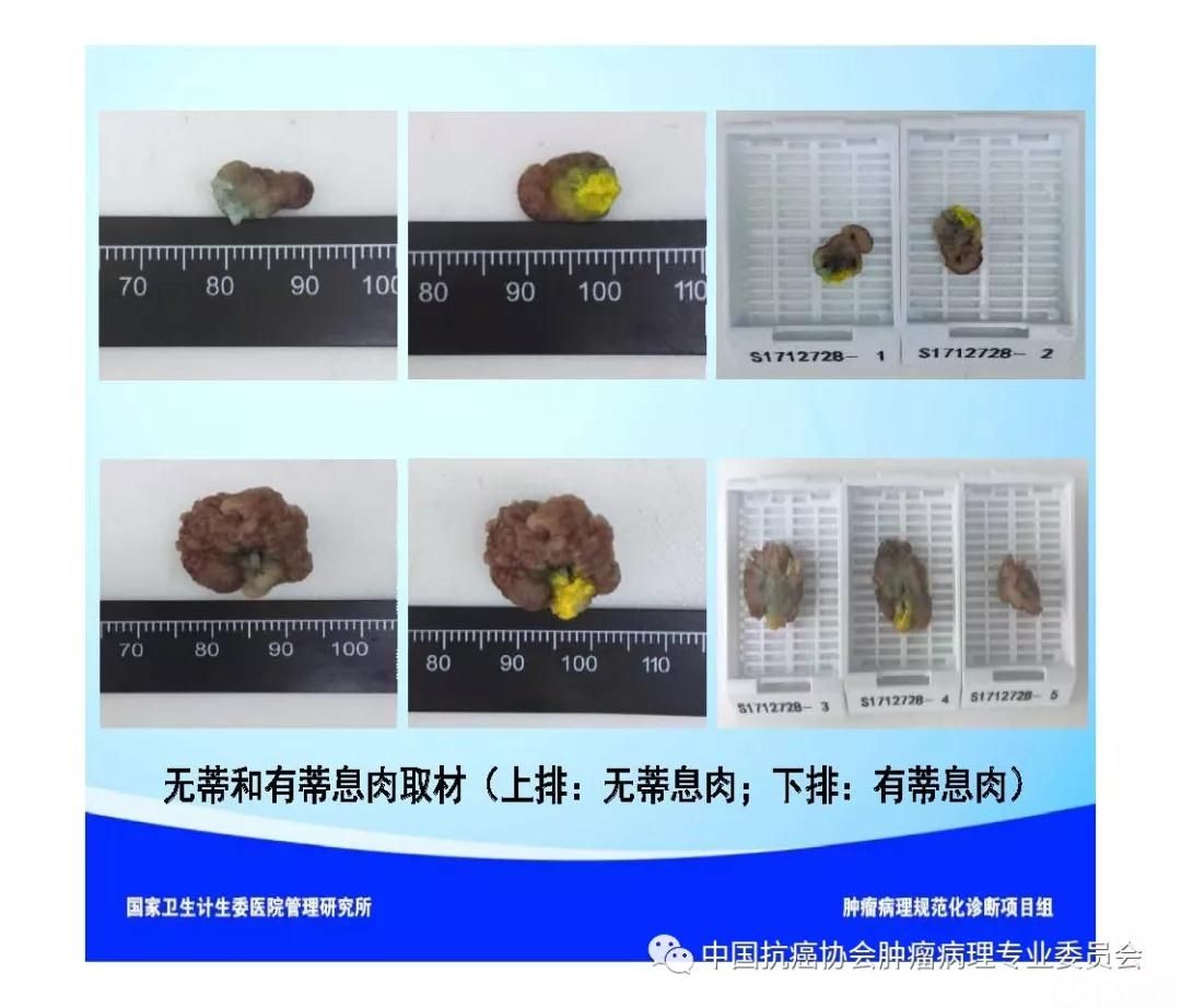 肿瘤病理诊断规范 第9部分:结直肠癌病理诊断规范