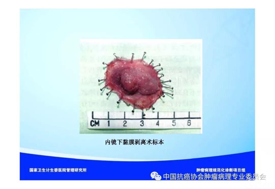 肿瘤病理诊断规范 第9部分:结直肠癌病理诊断规范