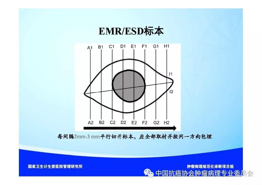 肿瘤病理诊断规范 第9部分:结直肠癌病理诊断规范