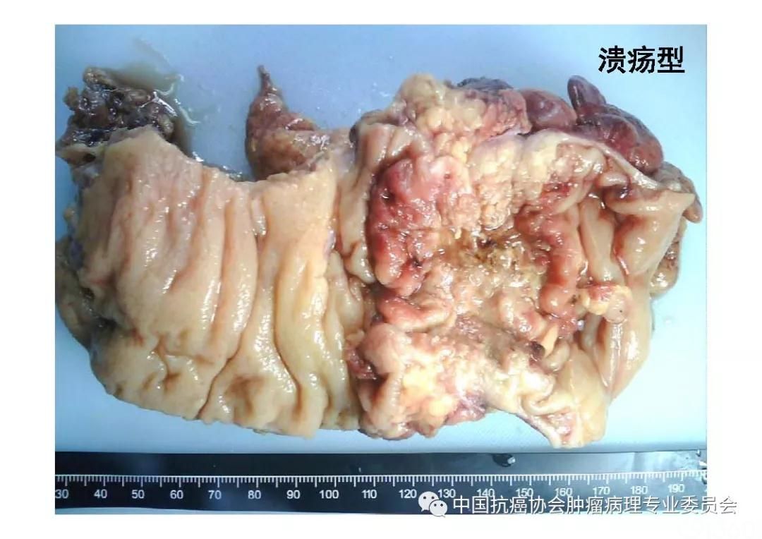 肿瘤病理诊断规范 第9部分:结直肠癌病理诊断规范
