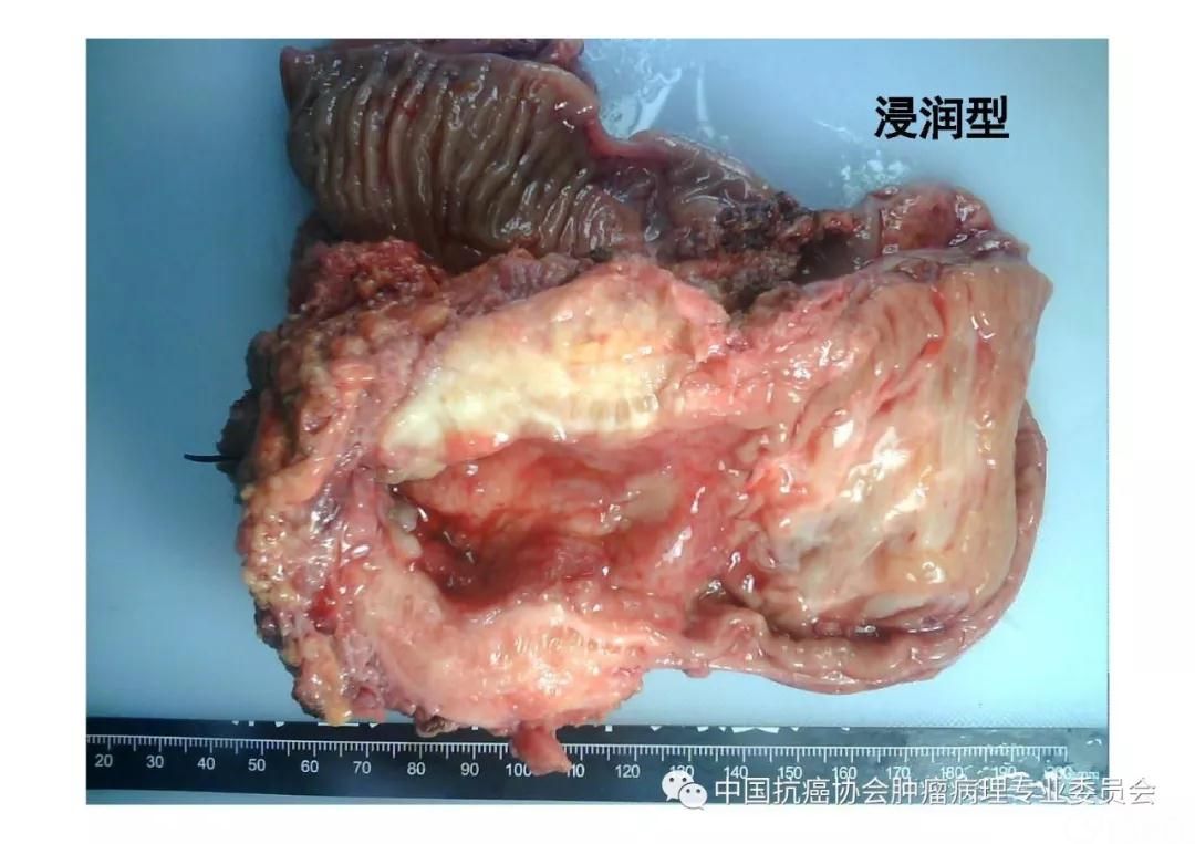 肿瘤病理诊断规范 第9部分:结直肠癌病理诊断规范
