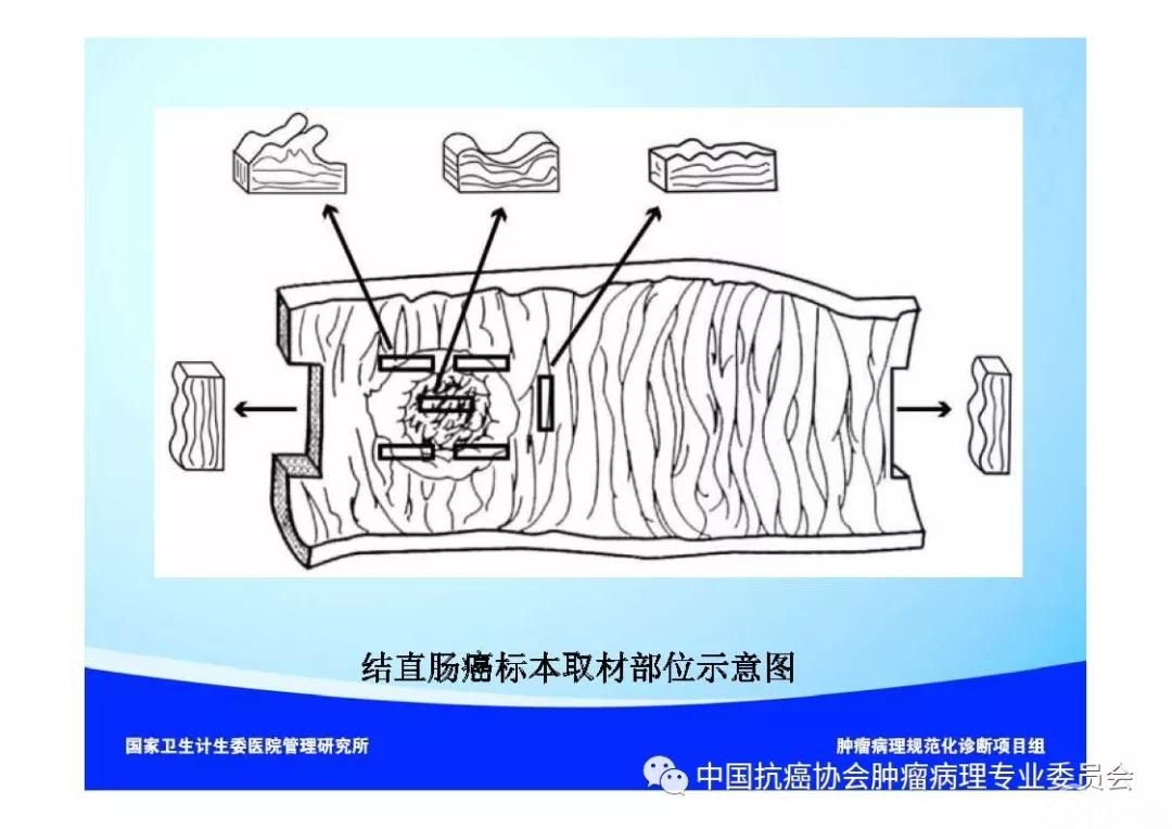 肿瘤病理诊断规范 第9部分:结直肠癌病理诊断规范