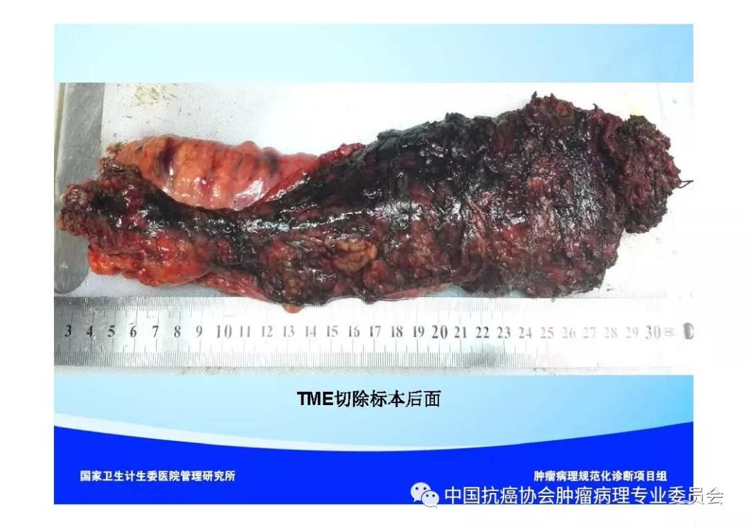 肿瘤病理诊断规范 第9部分:结直肠癌病理诊断规范