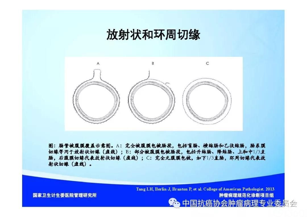 肿瘤病理诊断规范 第9部分:结直肠癌病理诊断规范