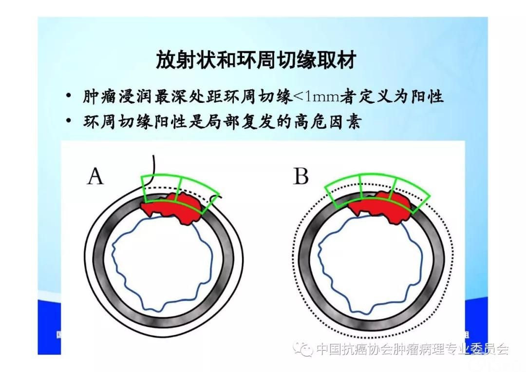 肿瘤病理诊断规范 第9部分:结直肠癌病理诊断规范