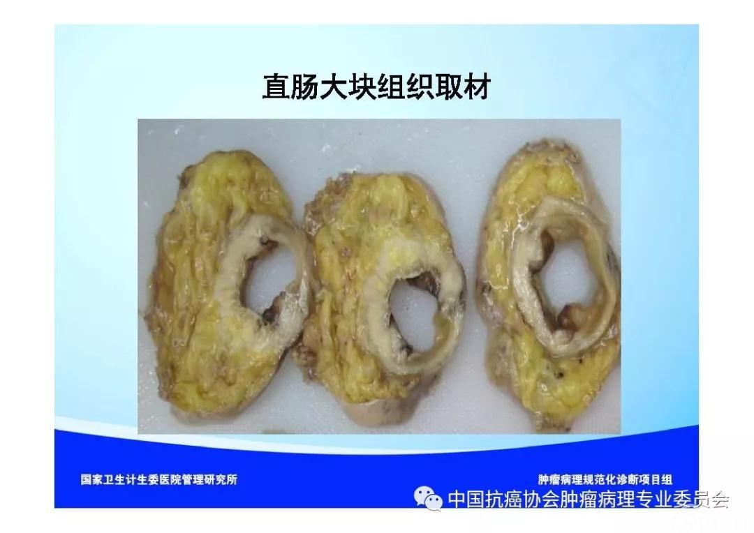 肿瘤病理诊断规范 第9部分:结直肠癌病理诊断规范